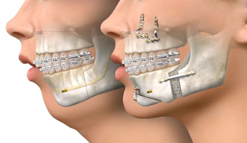 Illustration de chirurgie orthognathique avec appareils orthodontiques